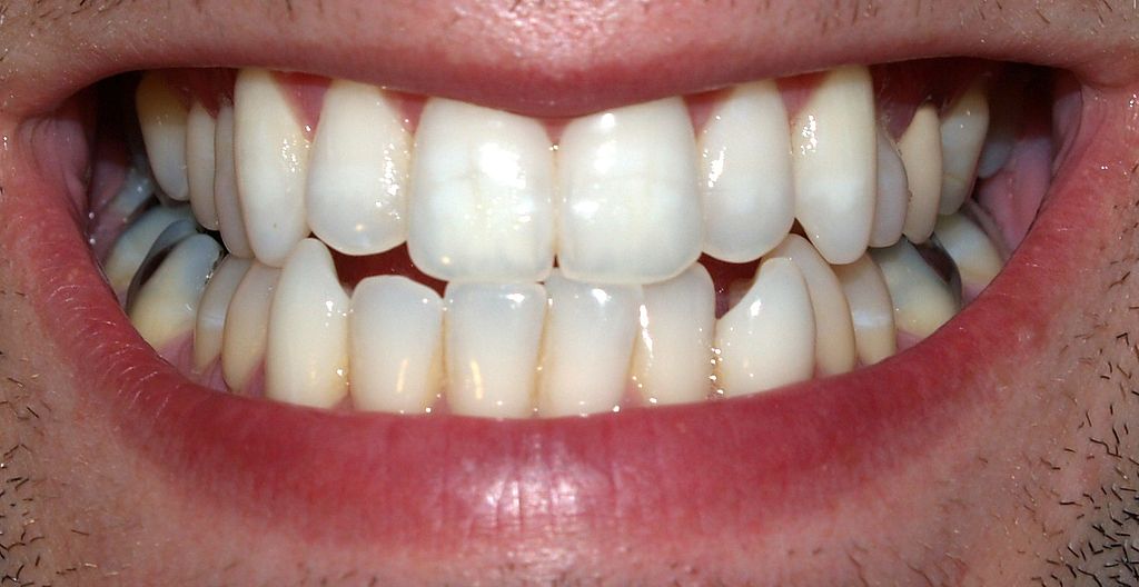 1024px-Teeth_by_David_Shankbone