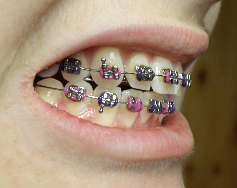 968px-Orthobraces_-_dental_braces